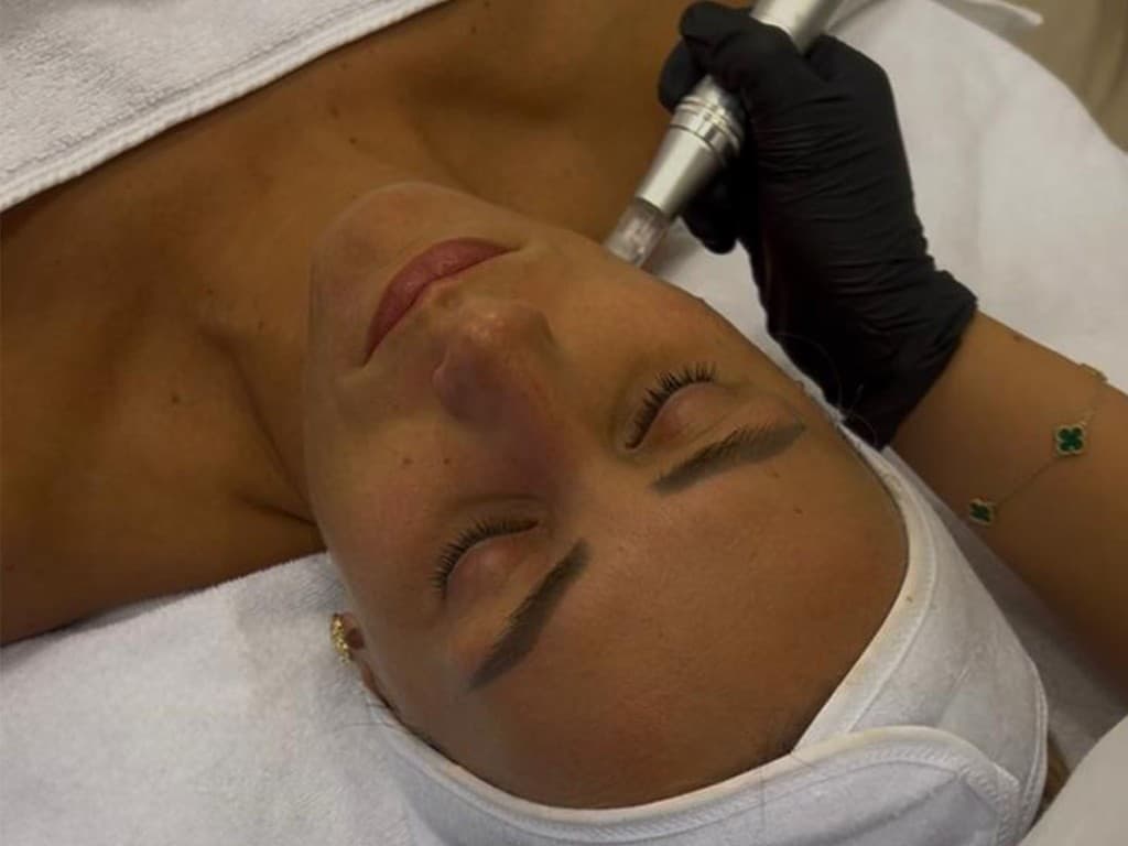 Dermapen (microneedling)