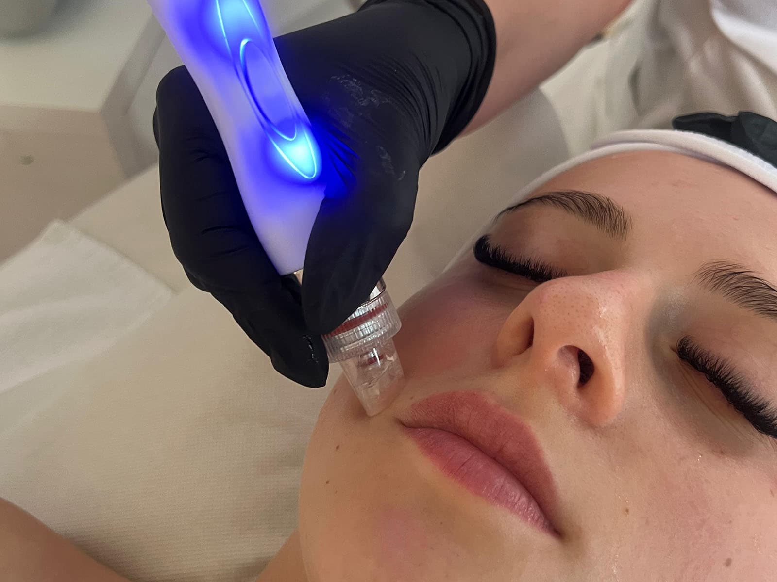 Hydrafacial
